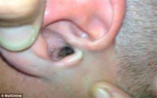 Клещ в ухе у человека: симптомы и лечение